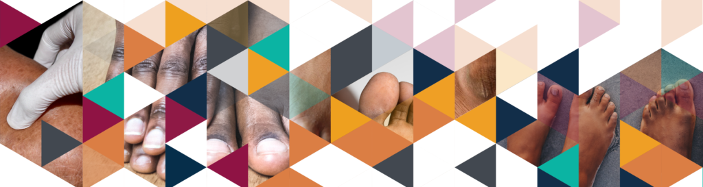 Handbook cover: Footcare in Dark Skin Tone (Diabetes Africa)